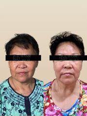 Before Korean face sculpting treatment — facial asymmetry and jaw slimming
