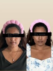 Before Korean face sculpting treatment — facial asymmetry and jaw slimming