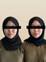 Before Korean face sculpting treatment — facial asymmetry and jaw slimming